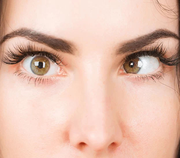 Squint Eye Surgery: See the World in a New Light!
